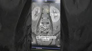 MRI Lumbar Spine Coronal Section t2trimcor Sequence Planning for beginners [upl. by Brighton]