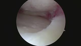 Knee Arthroscopy Partial Medial Meniscectomy Meniscus Surgery in a Patient with Mild Arthritis [upl. by Betteanne783]