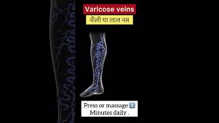 Varicose veins [upl. by Kaylil]