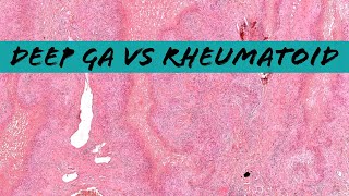 Deep Granuloma Annulare vs Rheumatoid Nodule palisaded necrobiotic granuloma pathology dermpath [upl. by Rehtae47]