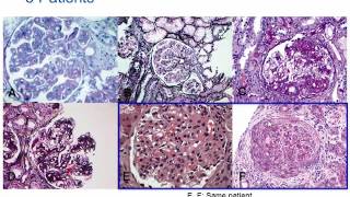 Understanding Membranoproliferative Glomerulonephritis Part 2 Hot Topic [upl. by Sax]