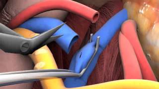 Lecture 26 Kidney transplant surgery [upl. by Aciram]