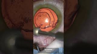 Curing post PRK Recurrent Erosions with diamond bur cornea [upl. by Noelle14]