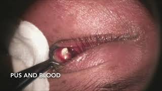 Incision and Drainage of Chalazion [upl. by Tnahs]