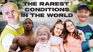 10 Of The Rarest Conditions In The World  BORN DIFFERENT [upl. by Yrac]