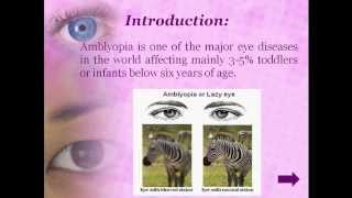 Therapies to cure Amblyopia [upl. by Frodi]