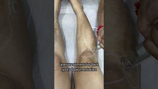 Laser treatment for Dark spots amp pigmentationpigmentation darkspots [upl. by Alrep]