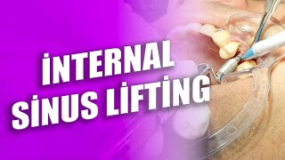 İnternal Sinus Lifting Nedir Nasıl Uygulanır [upl. by Gala512]