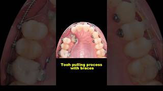 Pulling out hidden teeth when braces braces orthodontist dentist bracesoff [upl. by Lejeune]