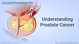 Prostate Cancer  Symptoms Diagnosis Staging Grading  Overview for Med Students [upl. by Crane]