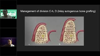 Rehabilitation of extremely atrophied jaw without bone augmentation [upl. by Aikahc]