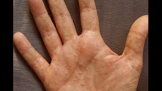 Dermatitis or Dyshidrosis How I Prevent Getting Painful And Unsightly Summer Hands [upl. by Wampler754]