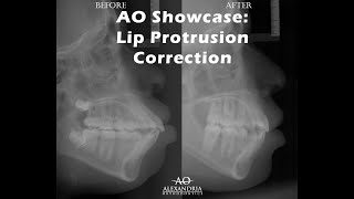 Alexandria Orthodontics Showcase Incisor protrusion correction with extractions [upl. by Katrine]