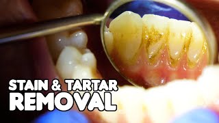 Dental Cleaning EXPLAINED  Stain amp Tartar Removal [upl. by Acisseg]