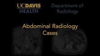 Small bowel obstruction [upl. by Godwin875]