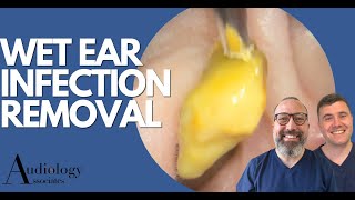 EAR INFECTION REMOVAL EP870 [upl. by Kcirrez273]