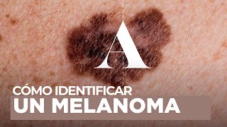 Melanoma qué es y cómo identificarlo [upl. by Hills]