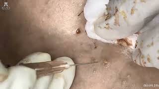 Big Cystic Acne Blackheads Extraction Blackheads amp Milia Whiteheads Removal Pimple Popping shorts [upl. by Thom51]