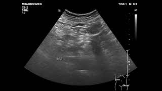 acalculous cholecystitis [upl. by Winni]