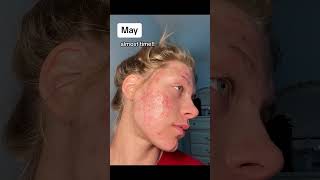 One year of acne scar progress in under 7 seconds acne skincare [upl. by Kirsteni]