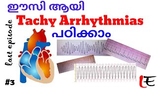 Basics of ECG episode 3 last episode in this series tachy arrythmias ST AFAFLSVT and VT [upl. by Anna-Diane731]