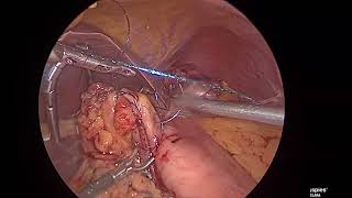 laparoscopic Excision of GIST lesser curve of stomach [upl. by Gnel]