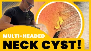 MULTIHEADED NECK CYST [upl. by Lancaster700]