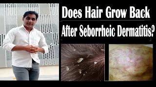 Does Hair Loss From Seborrheic Dermatitis Grow Back [upl. by Nayab]