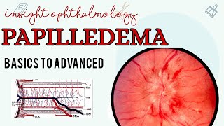 PAPILLEDEMA  OPTIC DISC SWELLING  EXPLAINED [upl. by Belayneh870]