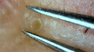 0289 keratin plug removal chin [upl. by Adrahc]