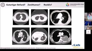 Krebstag Ruhr 2021 Lungenkarzinom Heilung auch bei Zweittumor oder Rezidiv [upl. by Aroda31]