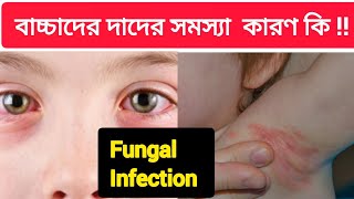 শিশুদের দাদের সমস্যা দাদফাঙ্গাল ইনফেকশন বাচ্চাদের চর্মরোগFungal InfectionRuksarParvinAR [upl. by Nalad793]