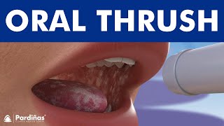 ORAL THRUSH  Candidiasis or yeast infection Angular cheilitis © [upl. by Arreip]