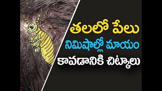 How to remove lice from hair at home in telugu  Thalalo pelu povalante em cheyali  తలలో పేలు [upl. by Jody]