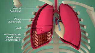 Pleural effusion  Internal medicine Etiology Clinical Features Diagnosis and Treatment Usmle [upl. by Schiff]