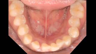 Aggressive periodontitis [upl. by Kabab]