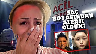 EN CİDDİ ALERJİLERDEN BİRİ KAFAM ŞİŞTİ SAÇ BOYASI [upl. by Ellek]