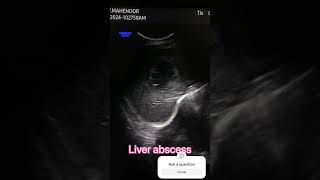 Liver abscess scanning… Subscribe like for ultrasound training medicalstudent radiology [upl. by Jean-Claude120]