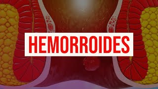 Hemorroides causas diagnóstico síntomas tratamiento y prevención almorranas y sangrado rectal [upl. by Letnuahs]