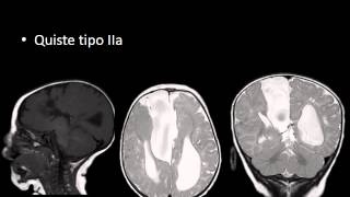 Anormalidades congenitas del SNC [upl. by Cordova]