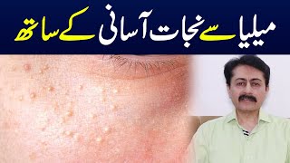 Milia causes symptoms and treatment  Dr Faisal Syed [upl. by Nebeur]