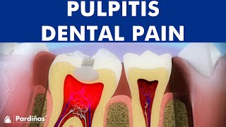 Pulpitis  Inflammation of tooth pulp © [upl. by Kubiak]