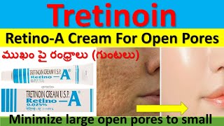 RetinoA cream for Open Pores  Tretinoin  Uses Working Dosage Side effects Precautions in tel [upl. by Aniez]