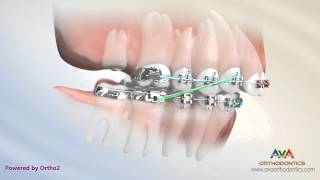 Orthodontic Treatment for Overbite Overjet  Removing Second Molar [upl. by Pace529]