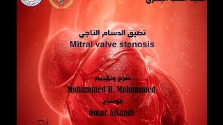 تضيق الدسام التاجي Mitral Valve Stenosis  جامعة دمشق  SMV [upl. by Gretna]