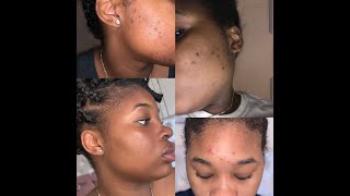 How I Cleared My Dark Spots amp Ingrown Hairs  IN DEPTH [upl. by Pantin955]