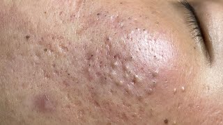 ACNE TREATMENT BO NGUYEN  Blackheads On Boy Face 2024FULL [upl. by Soilissav169]