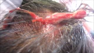 Scalp Abscess [upl. by Dnalkrik271]