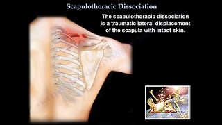 Scapulothoracic Dissociation  Everything You Need To Know  Dr Nabil Ebraheim [upl. by Unders]