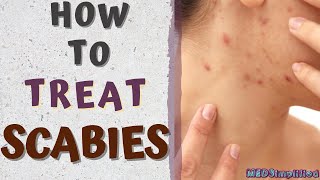 HOW TO TREAT SCABIESscabies treatment at home [upl. by Aicitan]